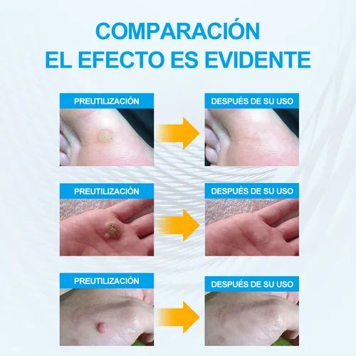 FormuClear Parches Anti Verrugas ¡108 parches!